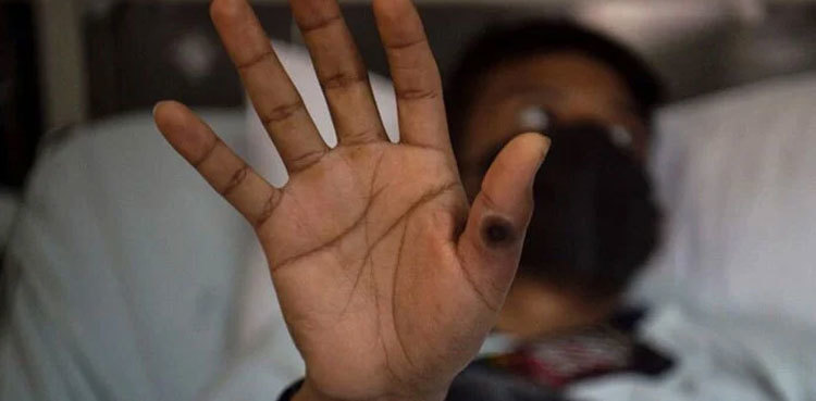 Pakistan puts airports on alert after detection of mpox cases