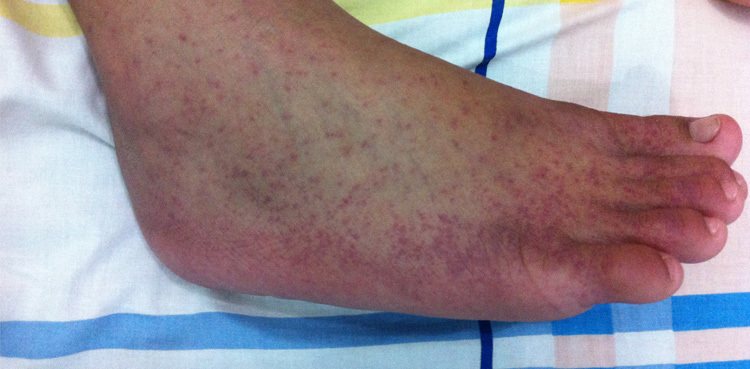 Karachi reports alarming surge in chikungunya, dengue cases