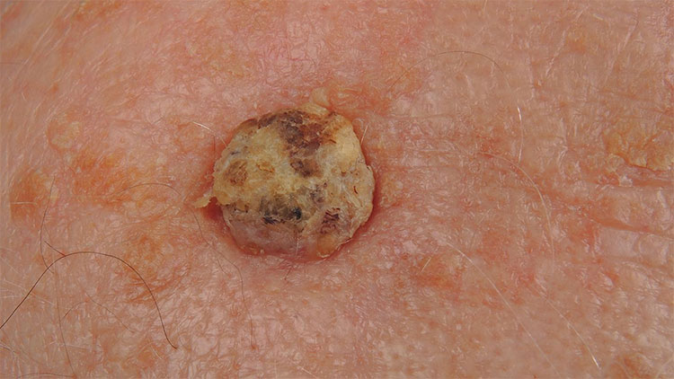 Unloxcyt: US approves skin cancer drug