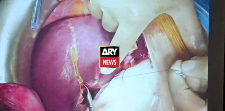 VIDEO: Doctors perform liver transplant surgery at Dow Hospital