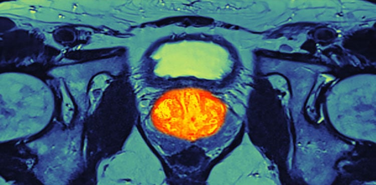 Abiraterone: Prostate cancer drug to be accessible in UK from coming week