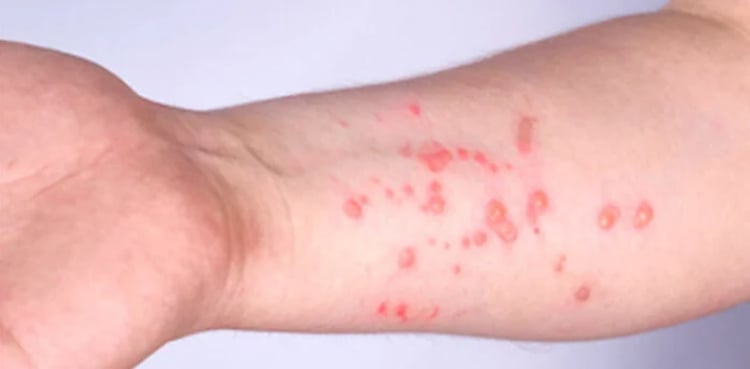 Sindh issues alert as mpox case confirmed in Karachi