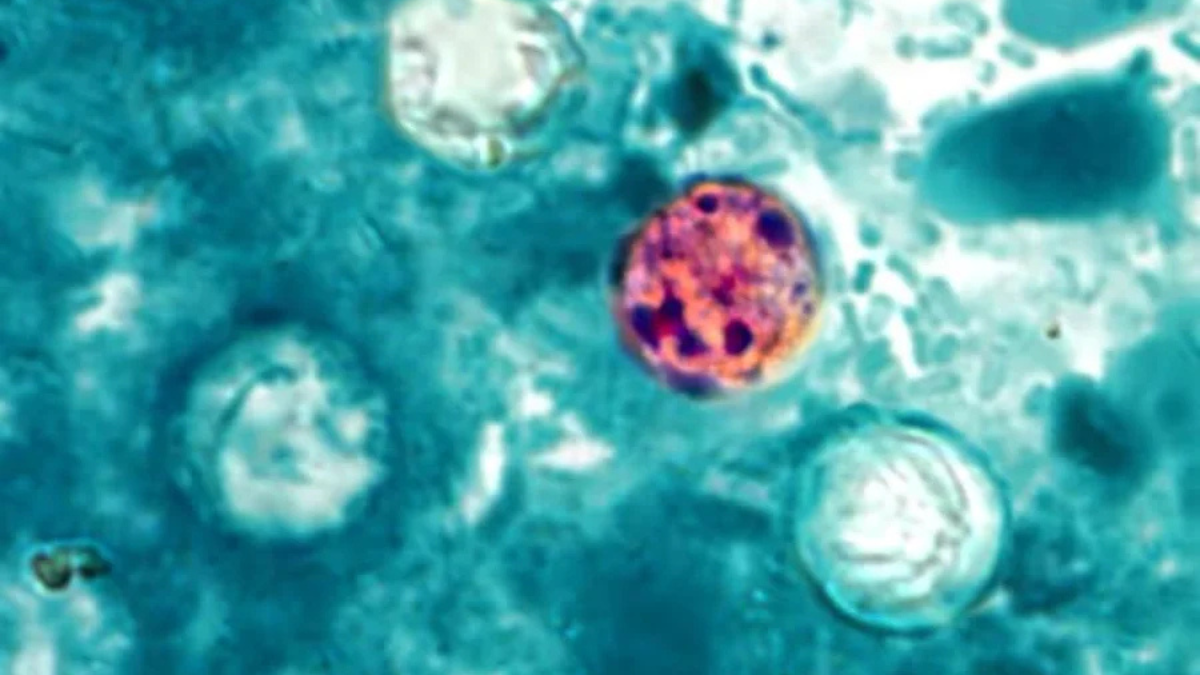 Intestinal parasite cases surge rapidly across the US