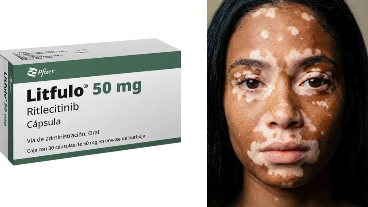 Litfulo: Drug restores skin pigmentation in late-stage vitiligo trials
