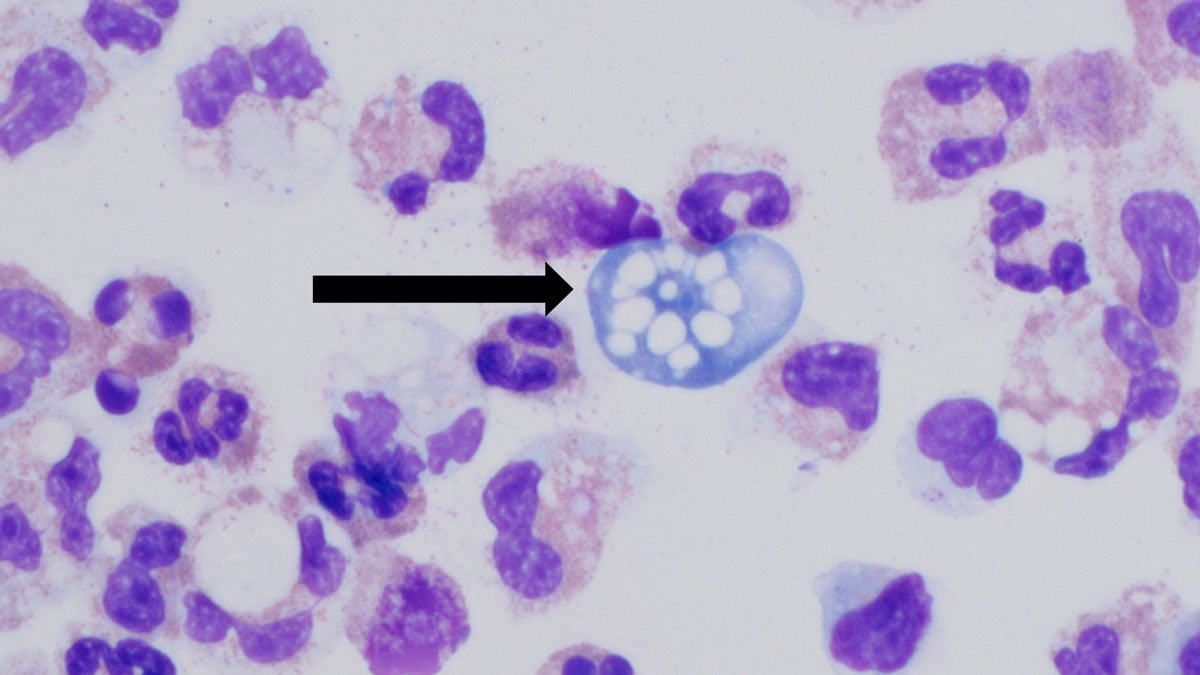 Karachi: Third naegleria death of the year sparks alarm among citizens