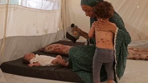 ‘All these rashes’: chickenpox surges in Gaza camps